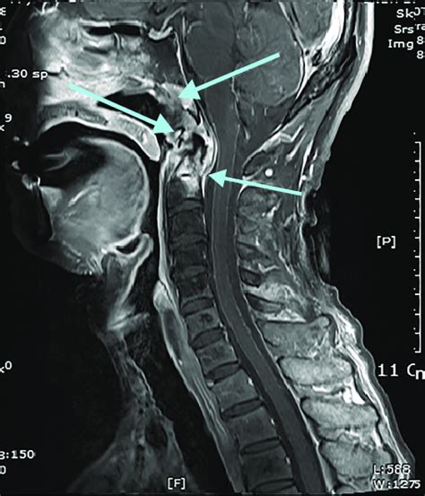 Magnetic Resonance Imaging of the Cervical Spine.